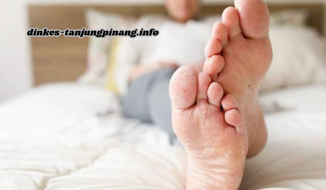 Tips Ampuh Mengatasi Kutu Air pada Kaki