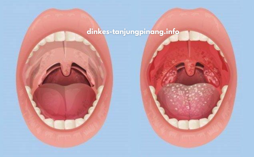 Cara Efektif Mencegah Sakit Amandel